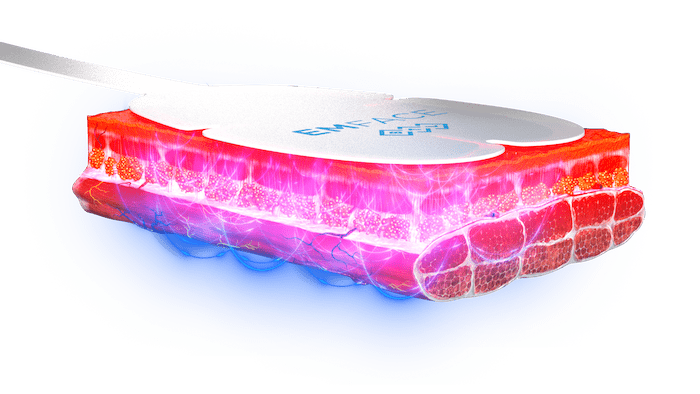 Emface_PIC_Applicator-skin-RF-HIFES