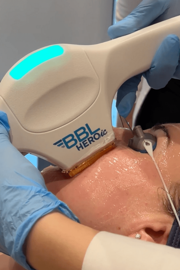 BBL HEROIC AI procedura REVÙ CLINIC