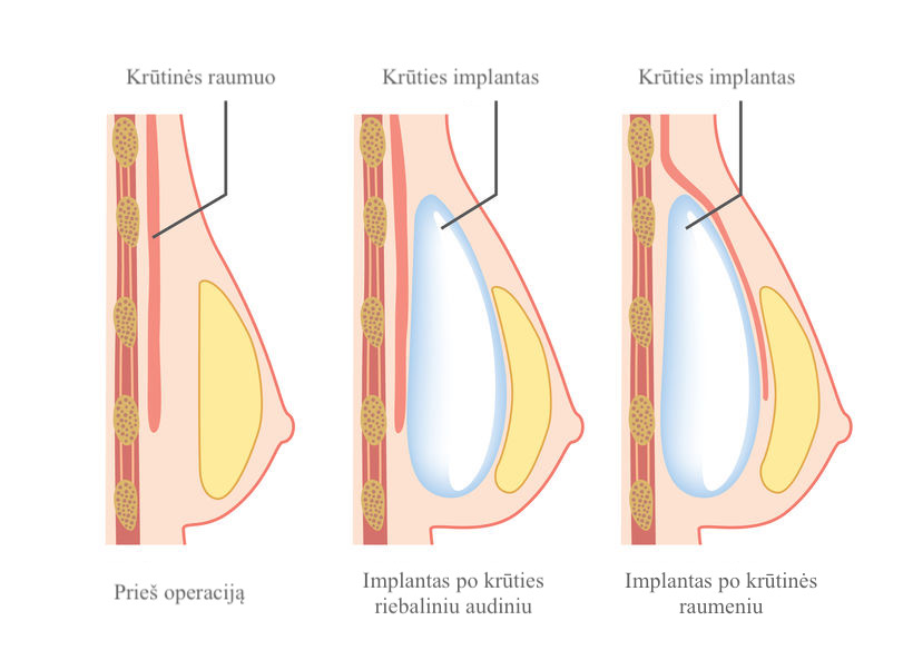 64910552 – breast implant insertion
