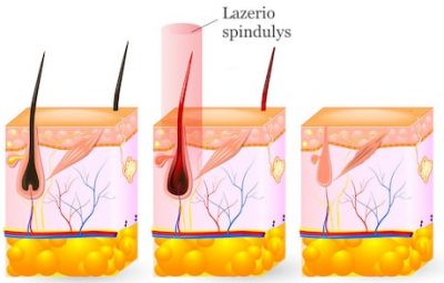 plauk-alinimas-lazeriu-rev-clinic